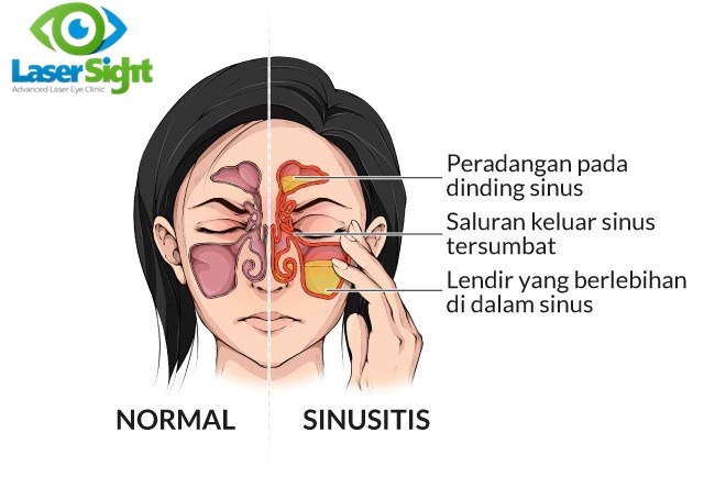 Penyakit Sinusitis